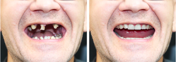 Rotten Teeth — What Causes the Condition?